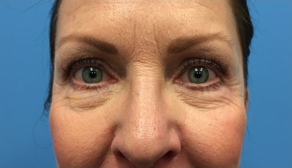 Lower-Blepharoplasty-Case--287 | Before Dr. Samir Rao 1