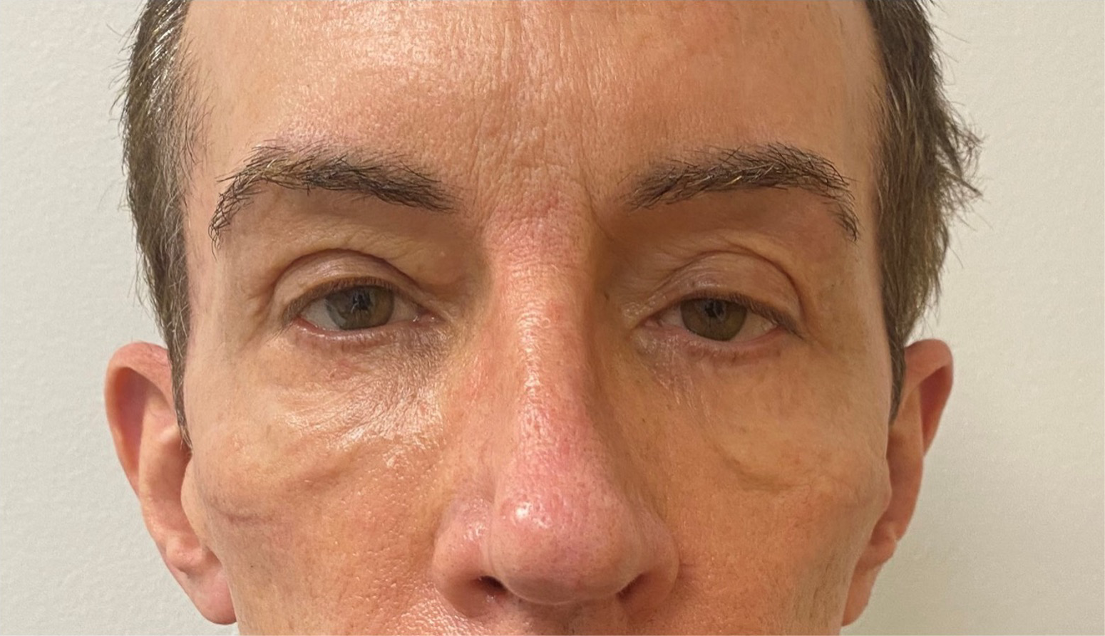 Quad-Blepharoplasty-Case--357 | Before Face 2