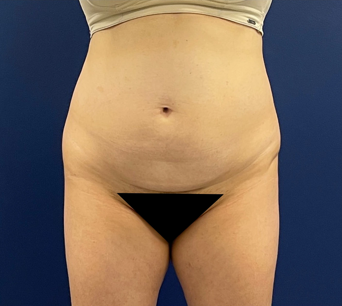 Abdominoplasty-Case--256 | Before Dr. Samir Rao 1