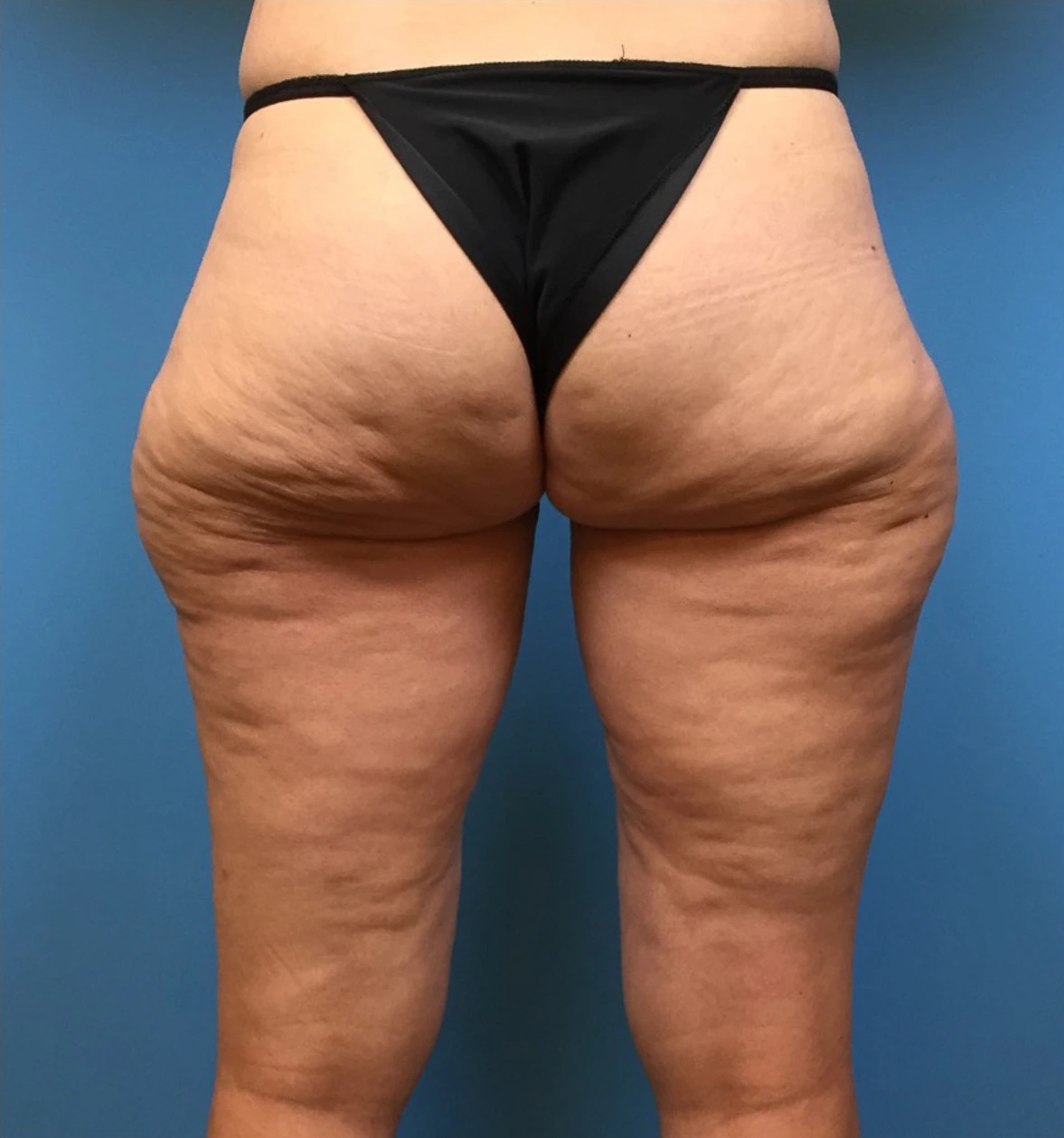 Case--281 | Before Liposuction 2