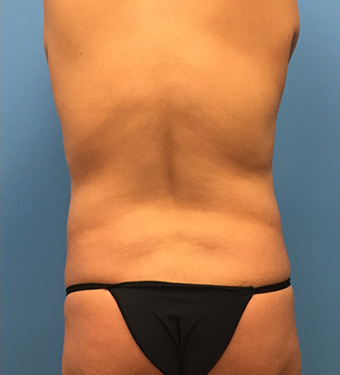 Case--65 | Before Liposuction 4