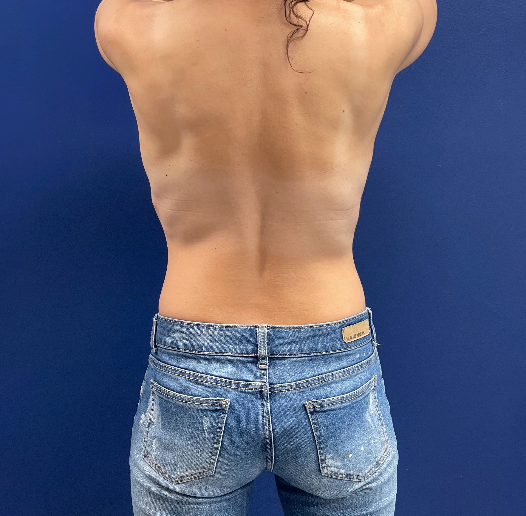 Breast-Augmentation-Lift-Case--28152 | Before Breast Augmentation With Lift 5