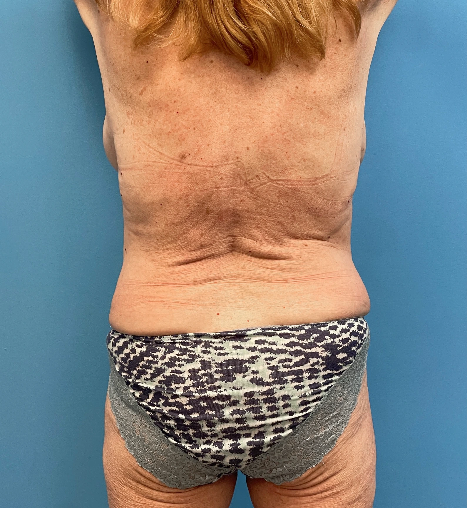 Lipoabdominoplasty-Case--27935 | Before Liposuction 4