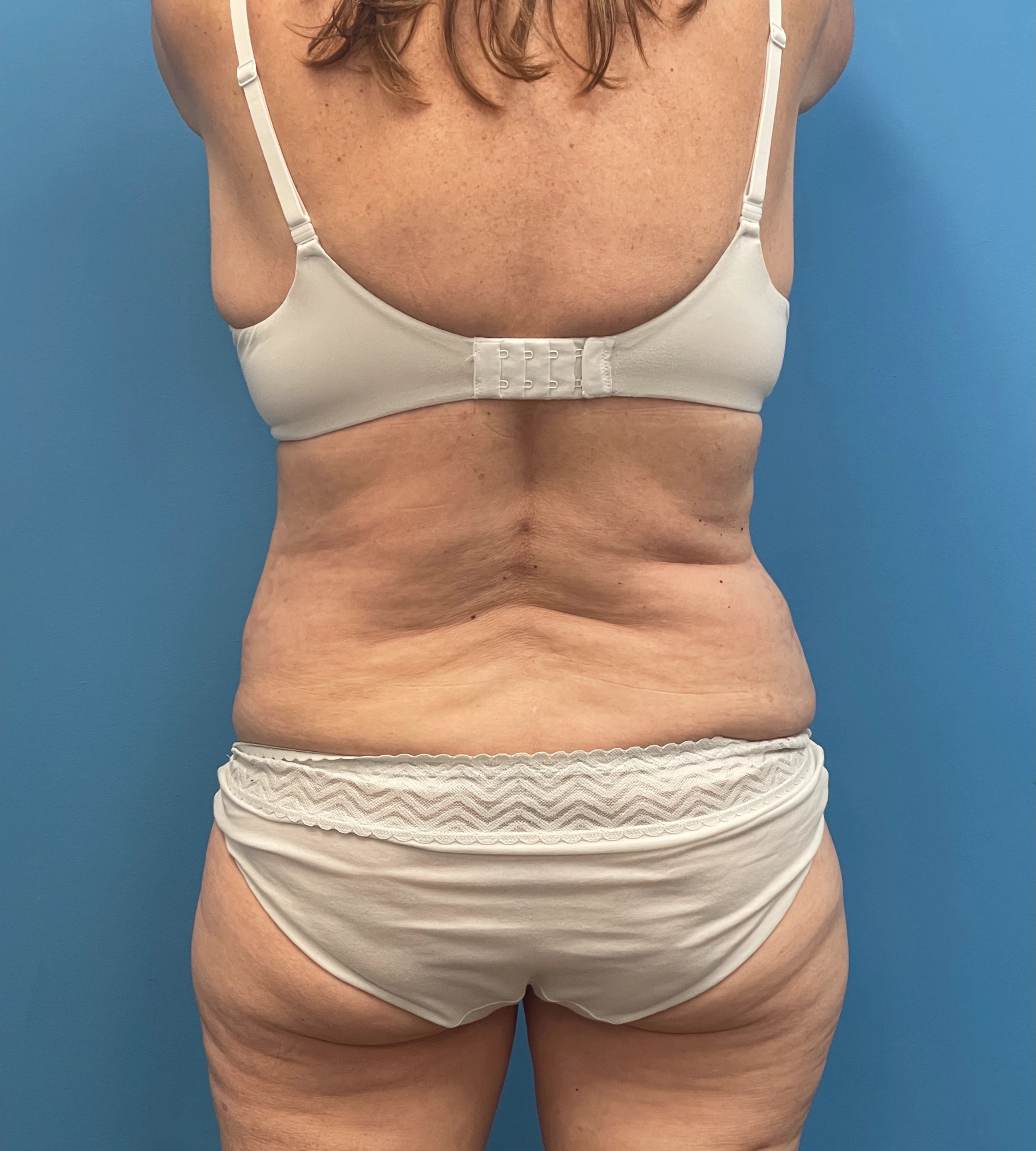 Abdominoplasty-Case--23690 | Before Liposuction 3
