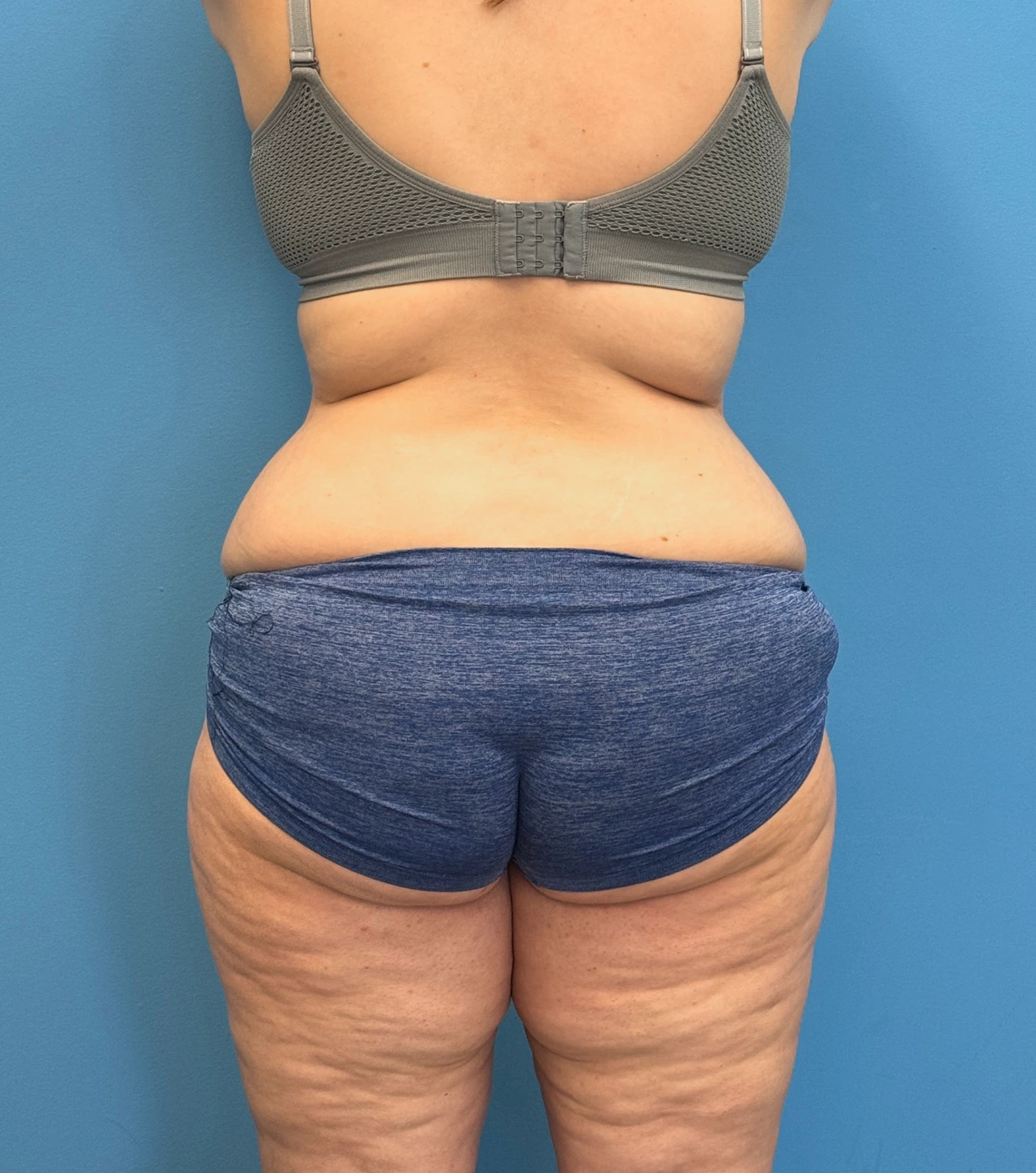 Tummy-Tuck-Case--28426 | Before Tummy Tuck 4
