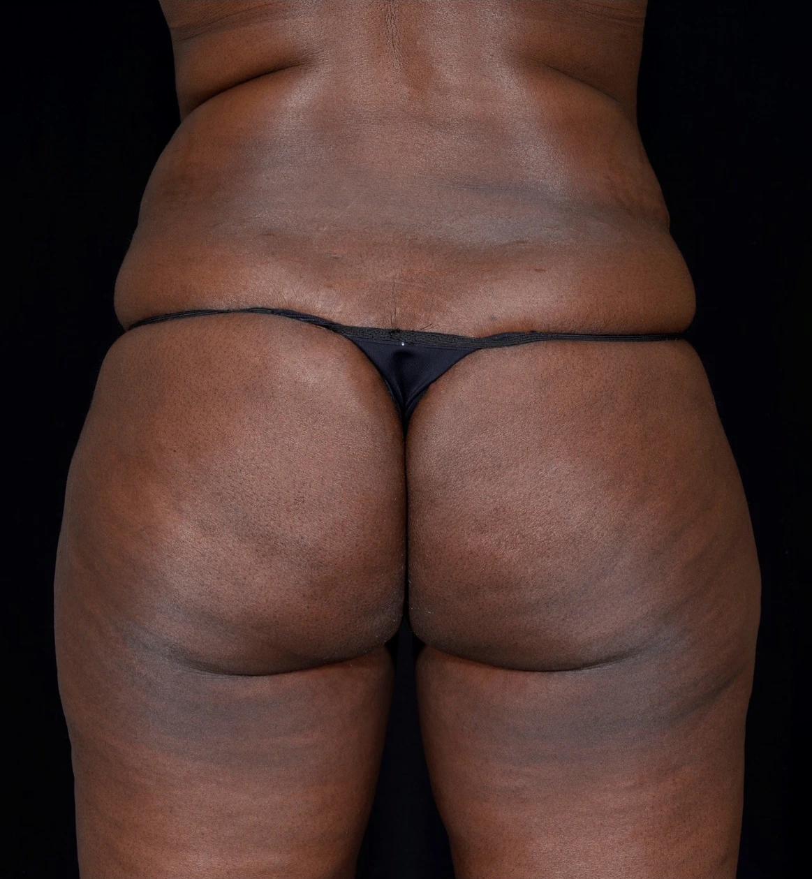Brazilian-Butt-Lift-Case--353 | Before Body 1
