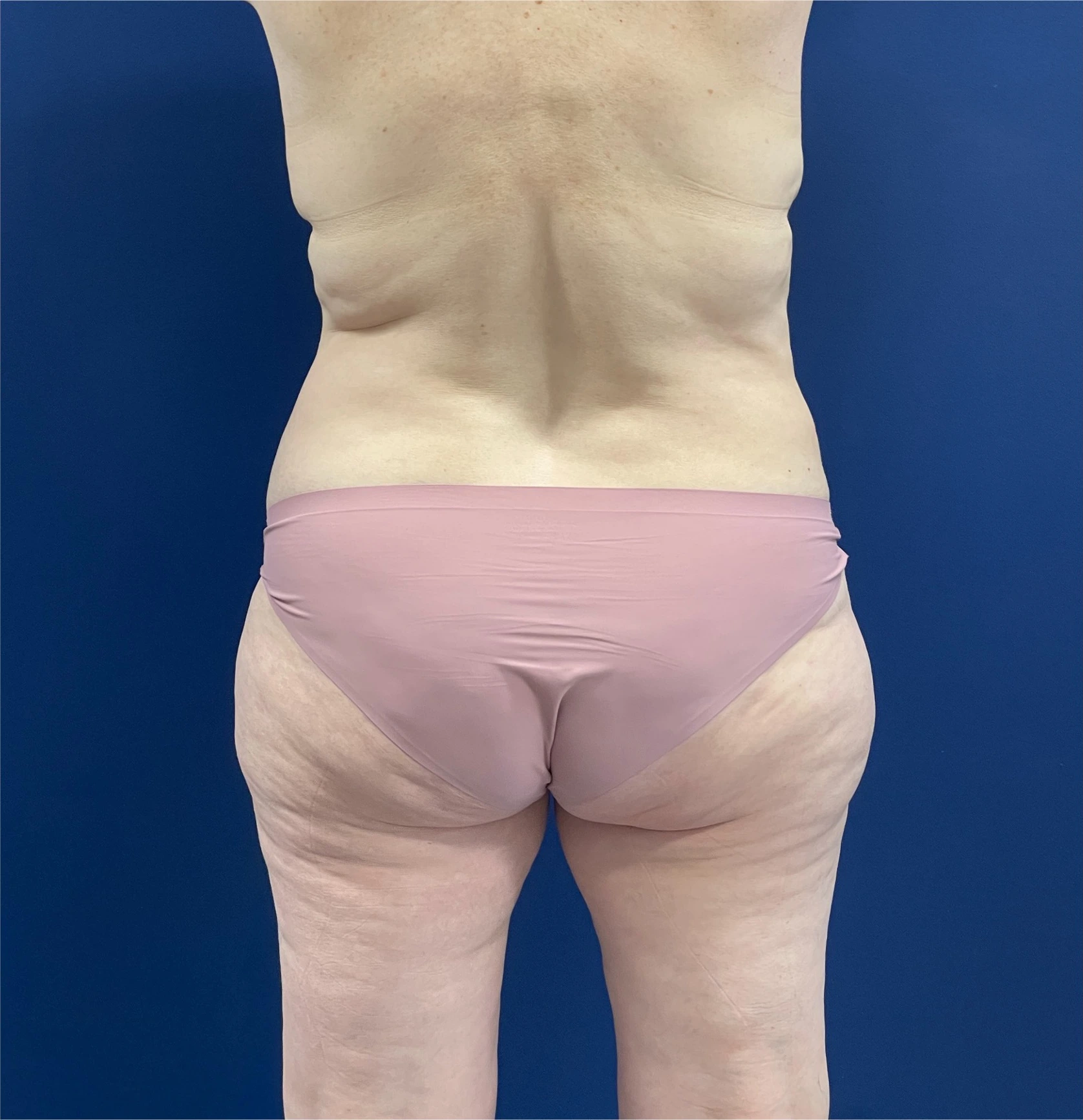 Mommy-Makeover-Case--26853 | Before Mommy Makeover 4