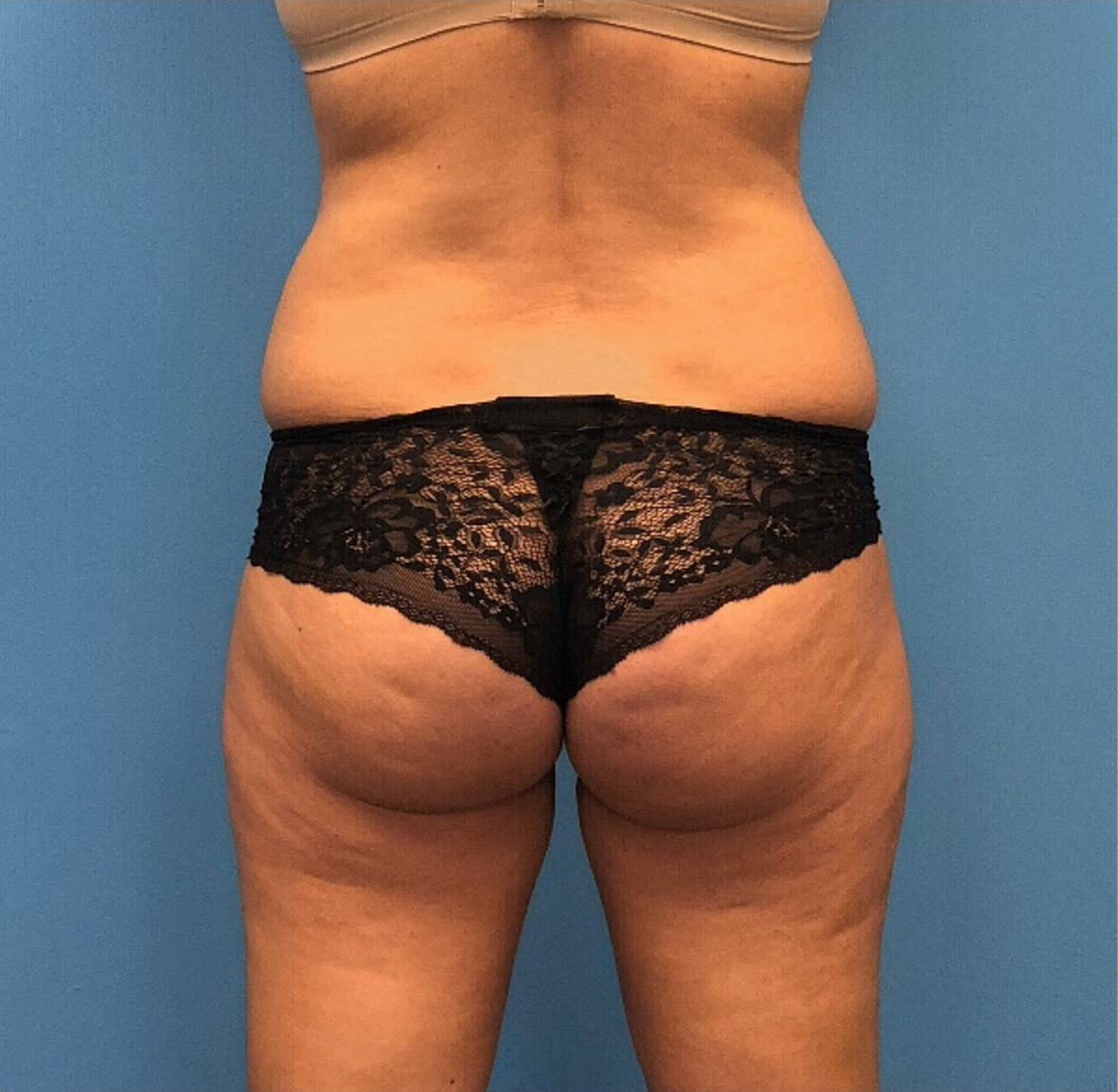 Lipo-360-Case--277 | Before Liposuction 3