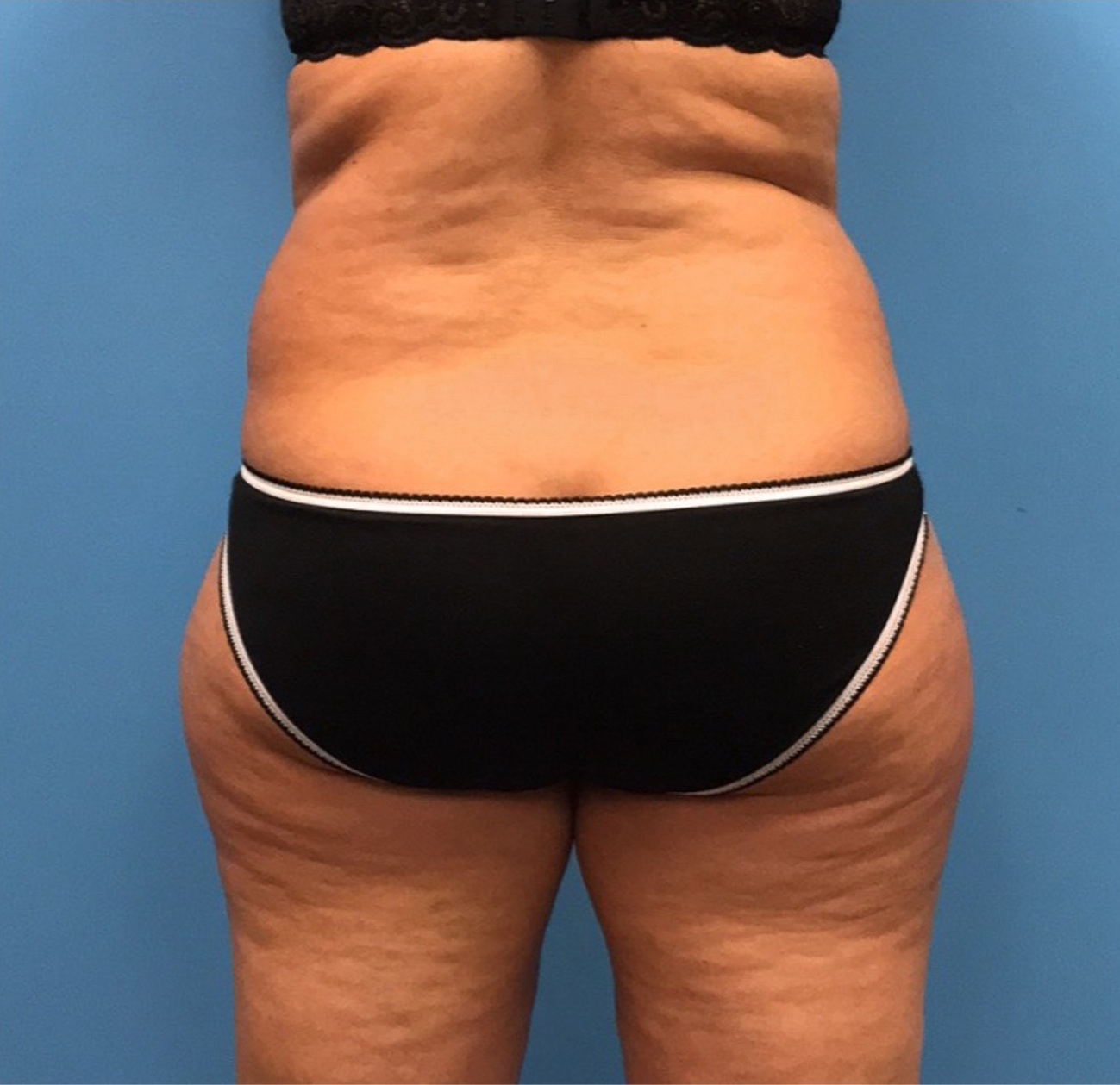 Liposuction-Case--72-1 | Before Liposuction 3
