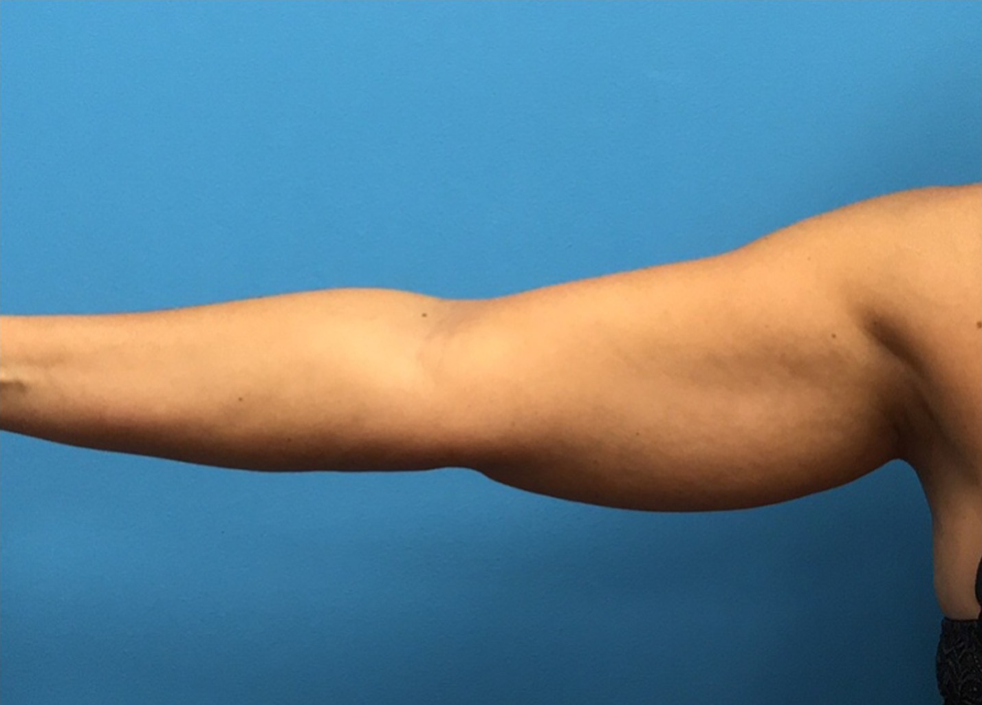 Case--280 | Before Liposuction 1
