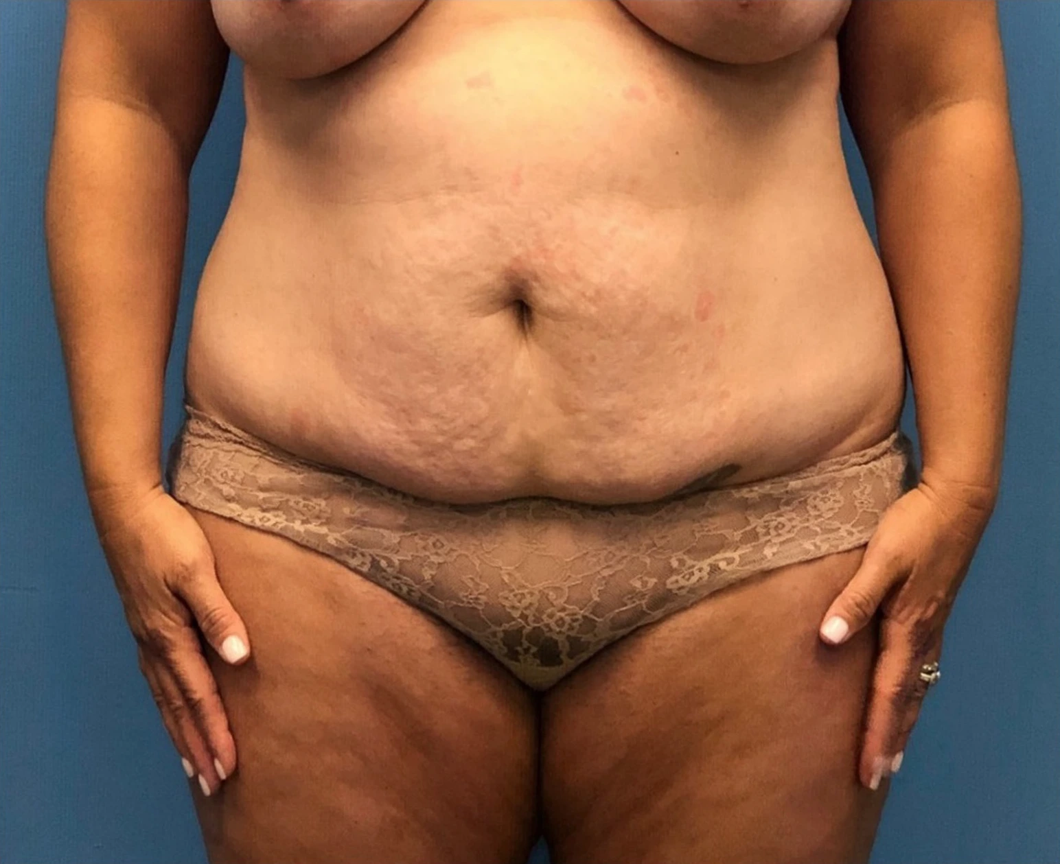 Case--252 | Before Liposuction 1