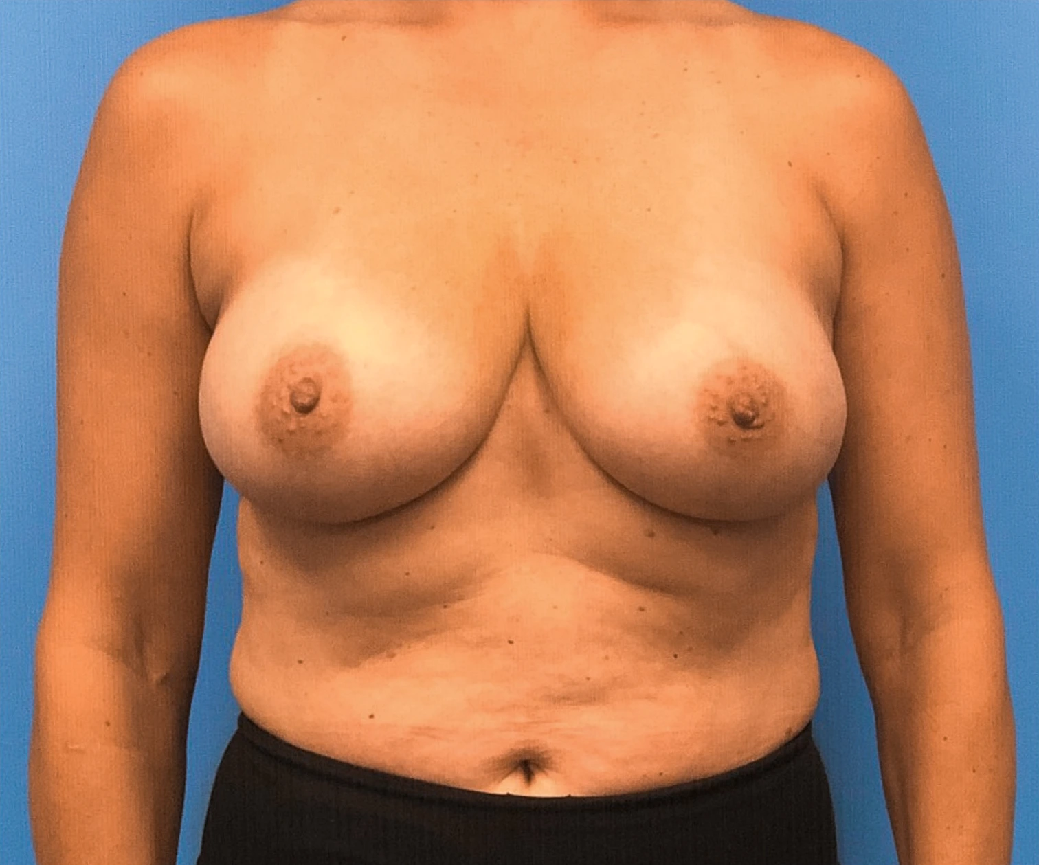 Breast-Reconstruction-Case--294 | Before Breast Reconstruction 1
