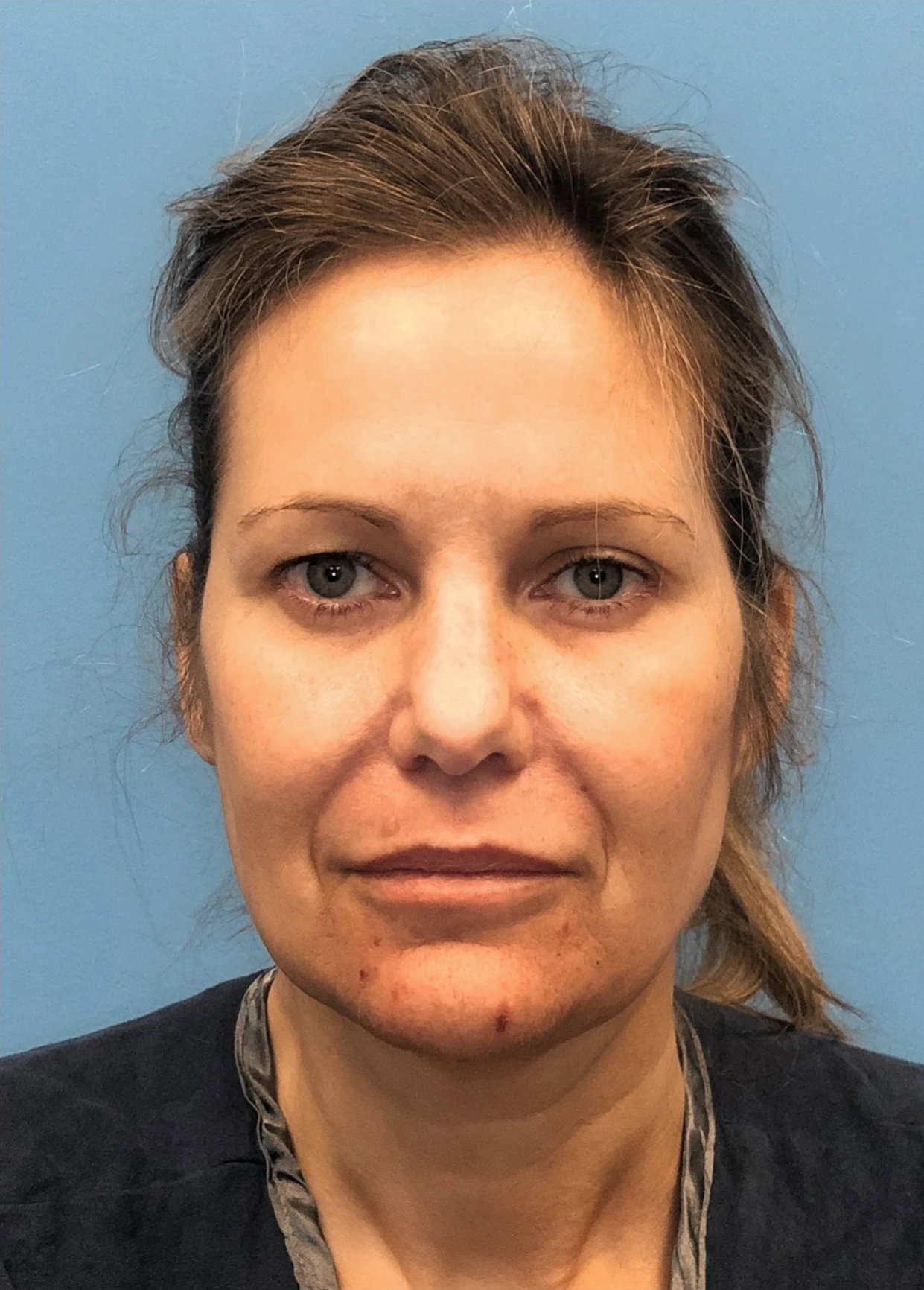 Facelift-Case--18078 | Before Face 1