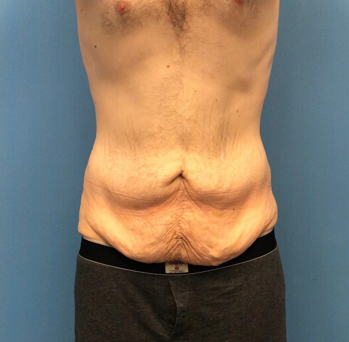Body-Lift-Case--273 | Before Dr. Samir Rao 1