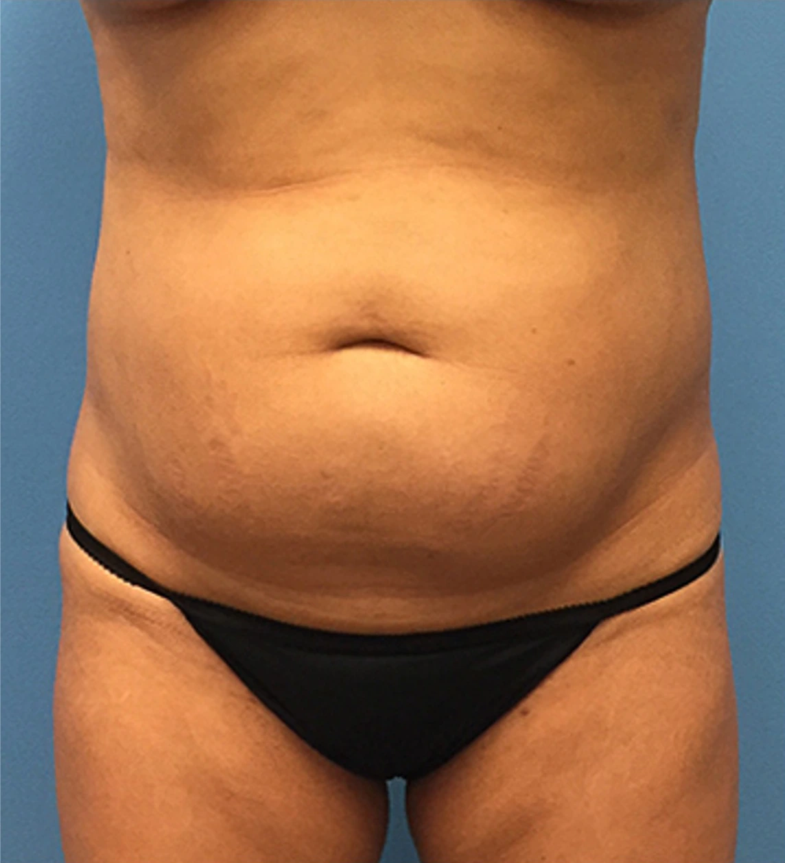 Case--65 | Before Body 1