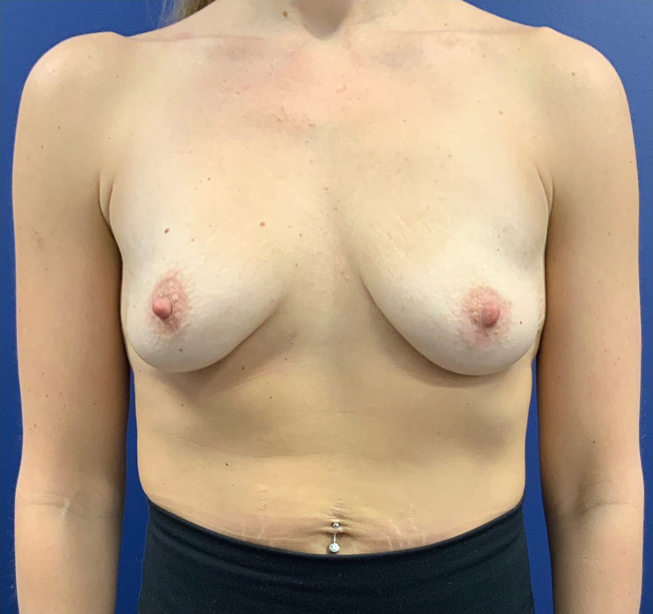Breast-Augmentation-Case--20570 | Before Breast Augmentation 1