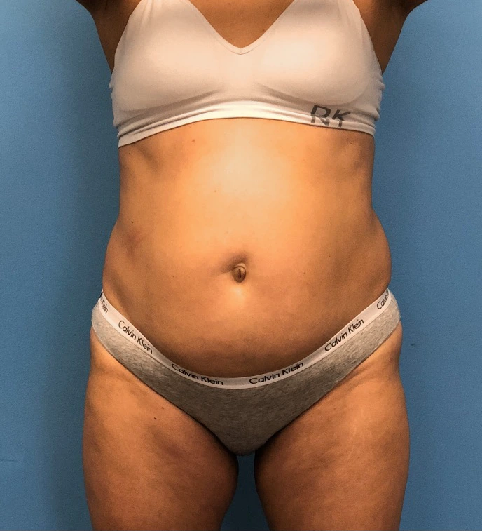 Case--14819 | Before Body 1