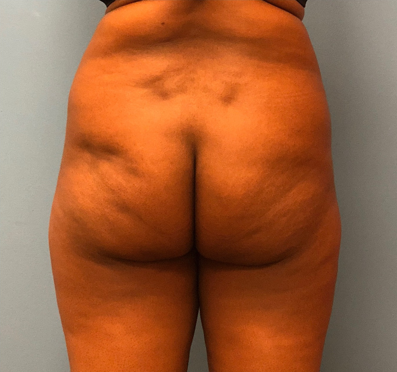 Brazilian-Butt-Lift-Case--13244 | Before Brazilian Butt Lift 1