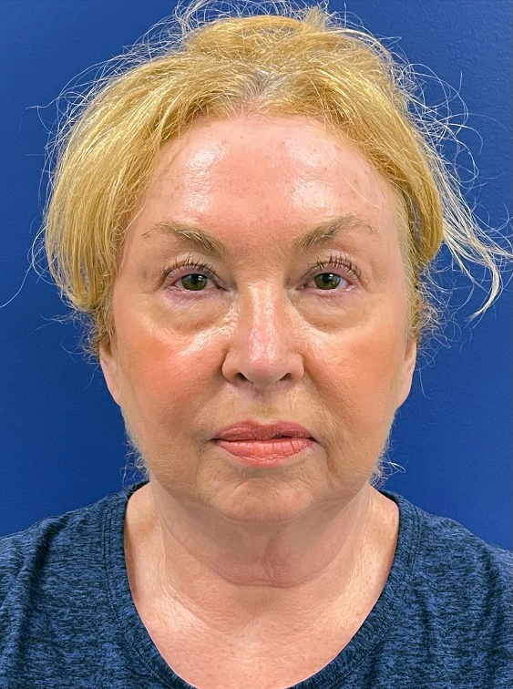 Facelift-Case--22860 | Before Face 1