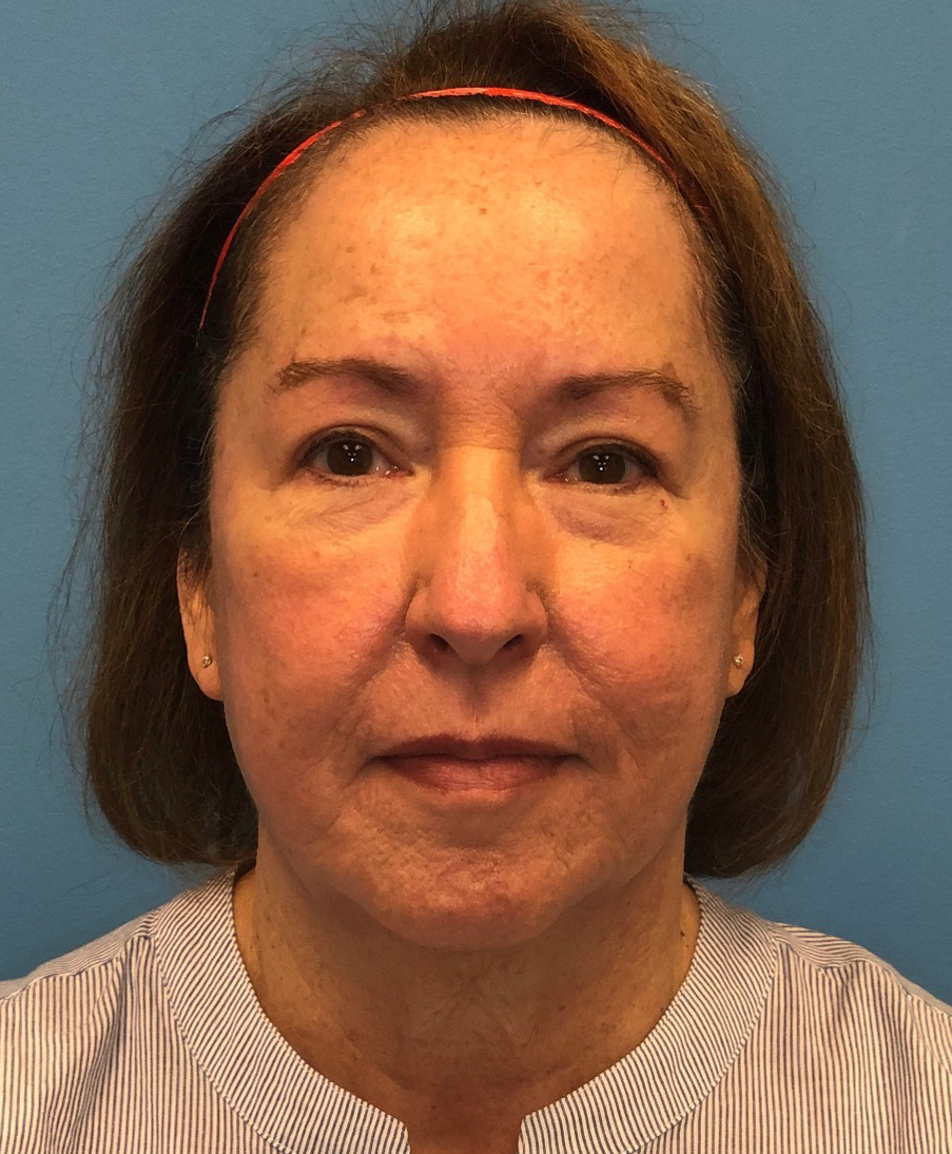 Facelift-Case--21241 | Before Face 1