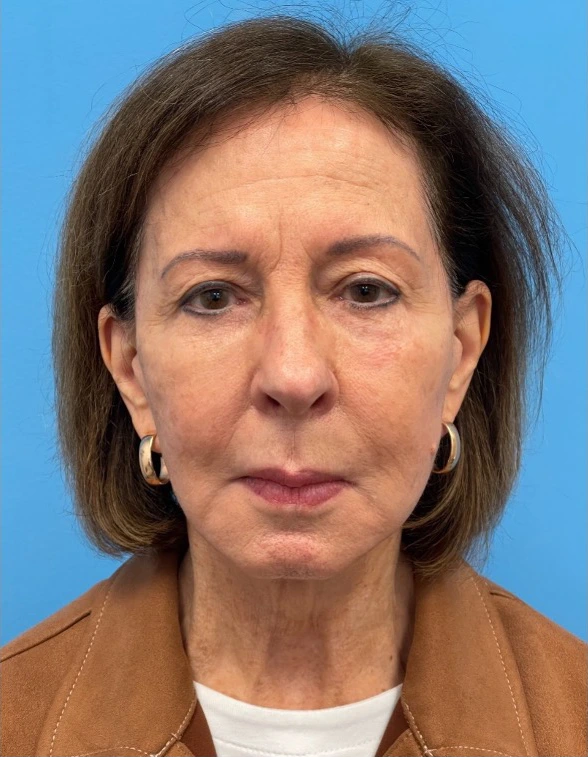 Facelift-Case--25941 | Before Dr. Samir Rao 1