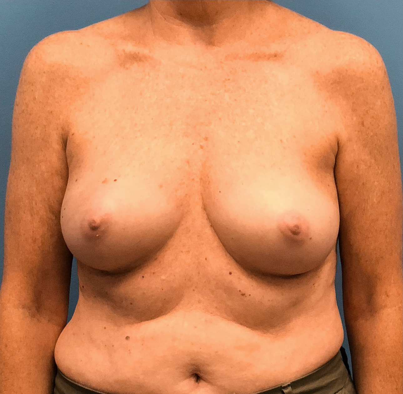Case--13861 | Before Breast Reconstruction 1