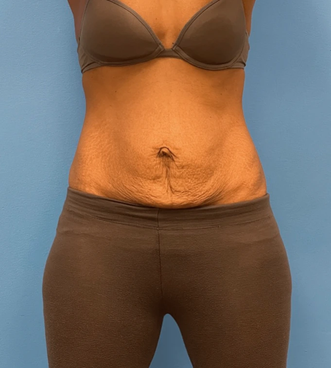 Abdominoplasty-Case--24922 | Before Dr. Samir Rao 1