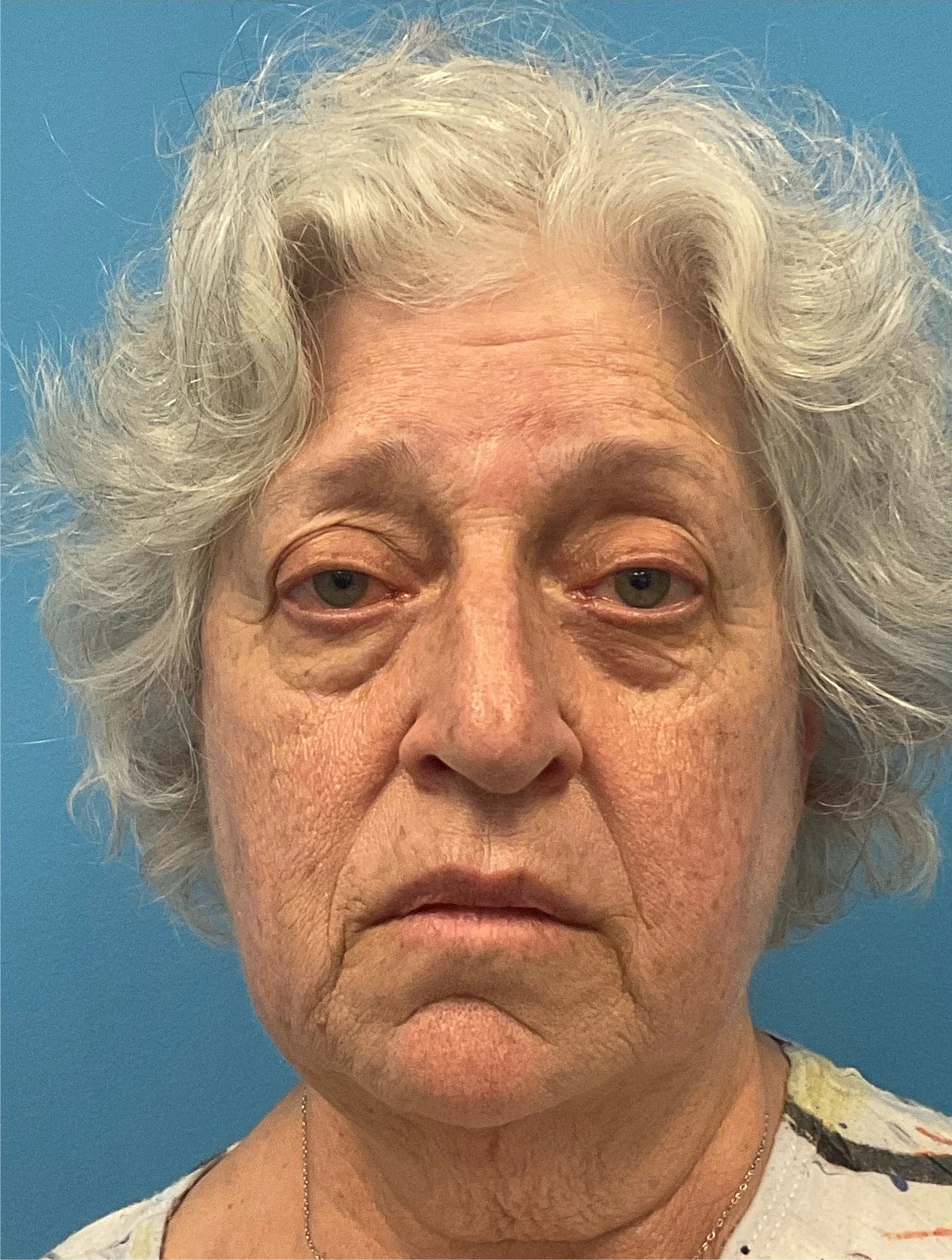 Rhinoplasty-Case--25467 | Before Rhinoplasty 5