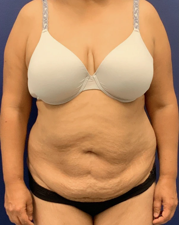 Liposuction-Abdominoplasty-Case--25576 | Before Liposuction 1