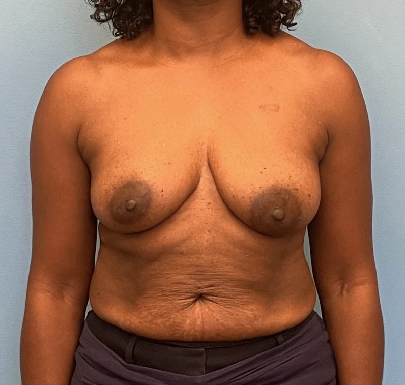Breast-Reconstruction-Case--23930 | Before Breast Reconstruction 1
