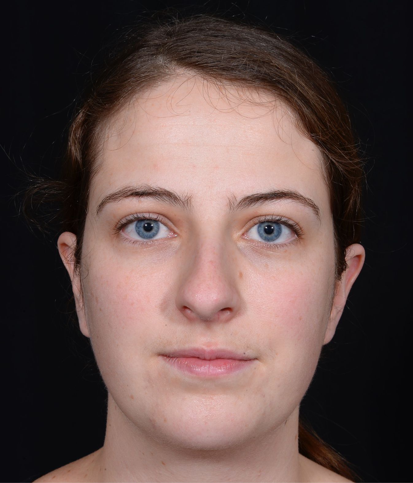 Rhinoplasty-and-Chin-Implant-Case--381 | Before Dr. Arjun Kanuri 1