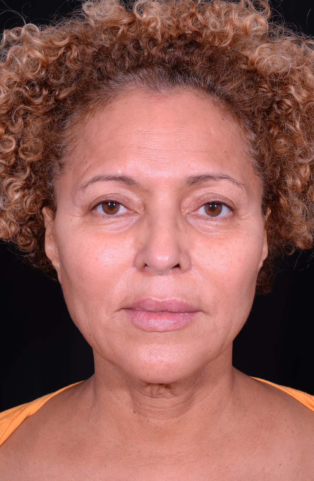 Facelift-Case--360 | Before Face 1