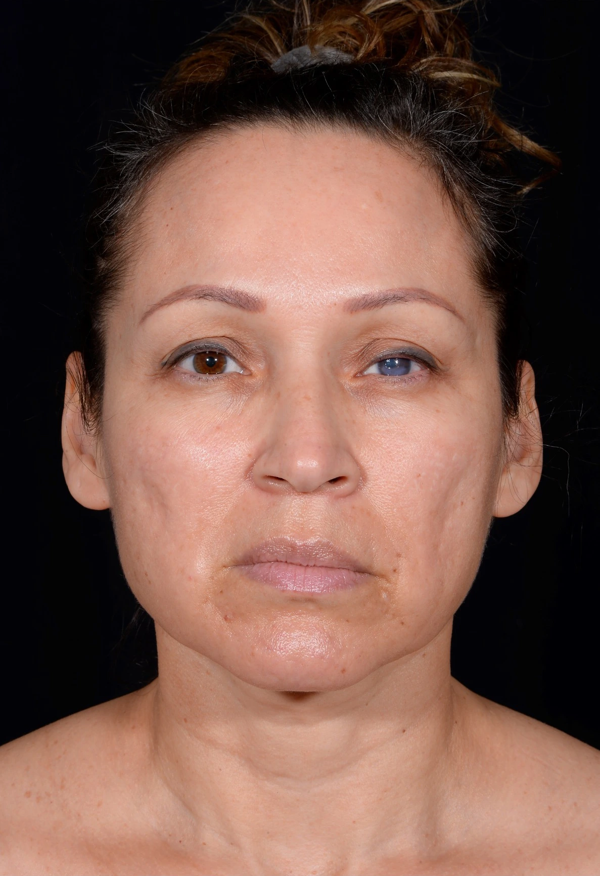 Facelift-Case--364 | Before Face 1