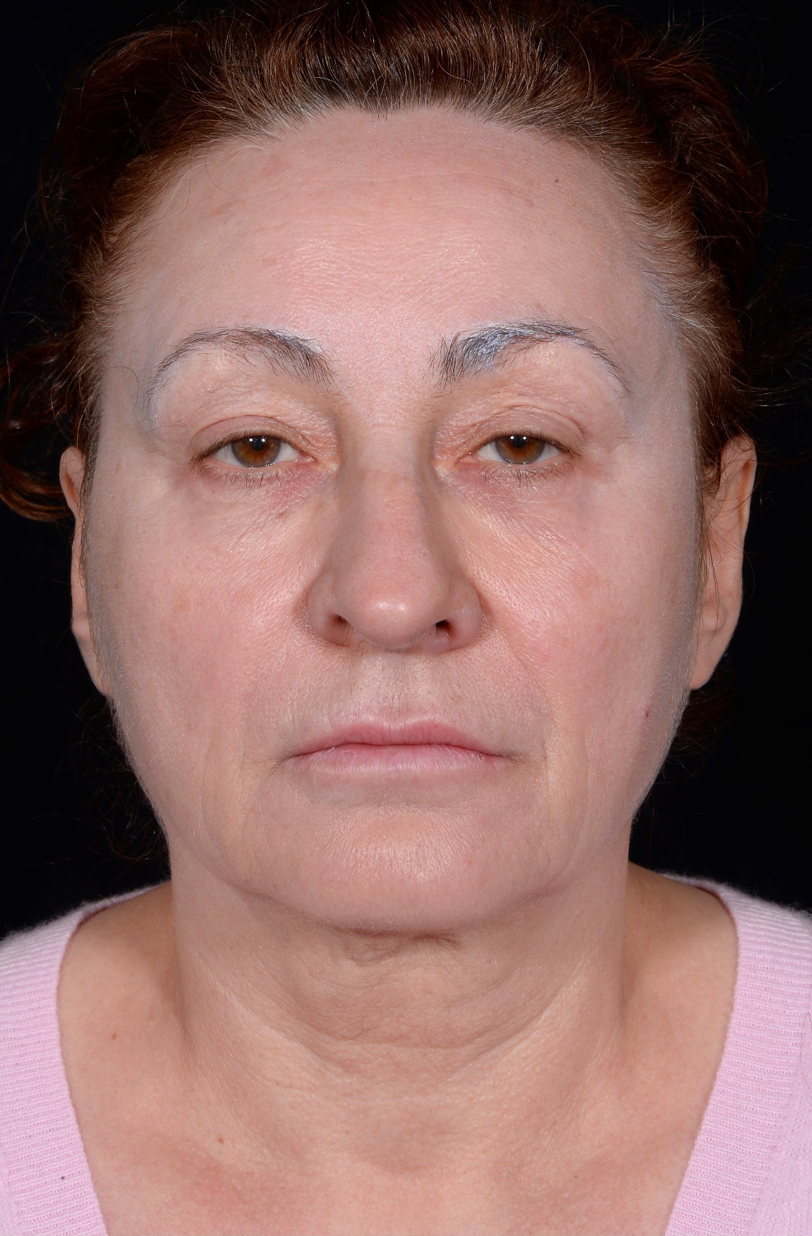 Facelift-Case--363 | Before Face 1