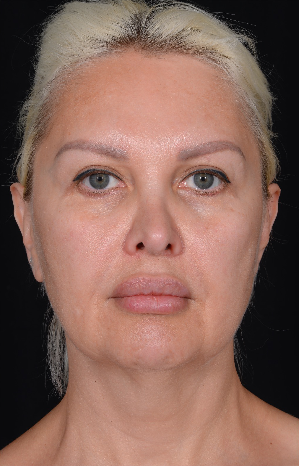 Facelift-Case--362 | Before Dr. Arjun Kanuri 1