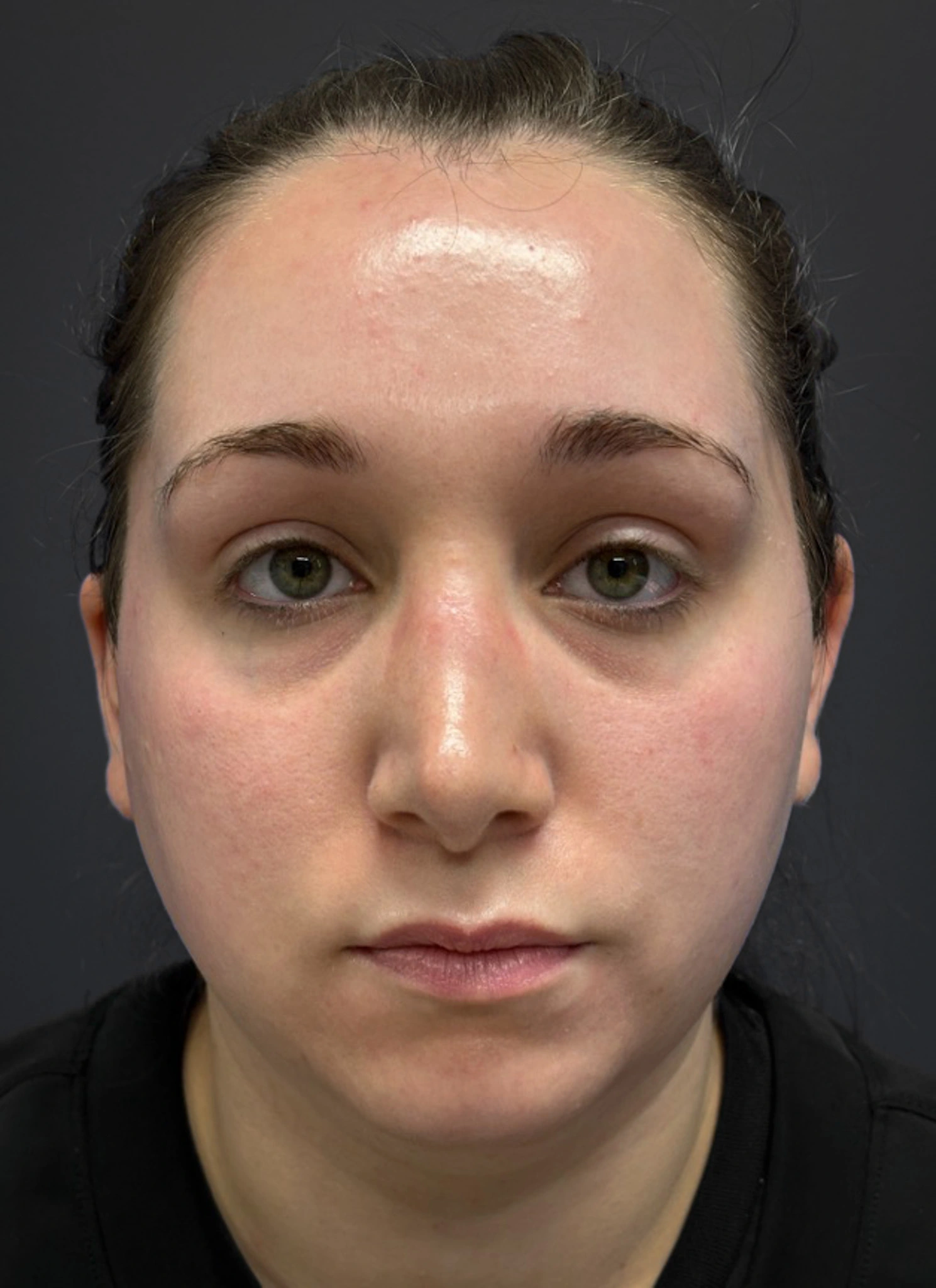 Submental-Liposuction-Case--3439 | Before Face 1