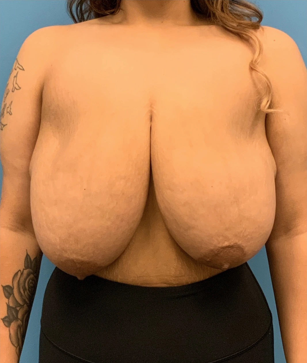 Breast-Reduction-Case--212 | Before Breast Reduction 1