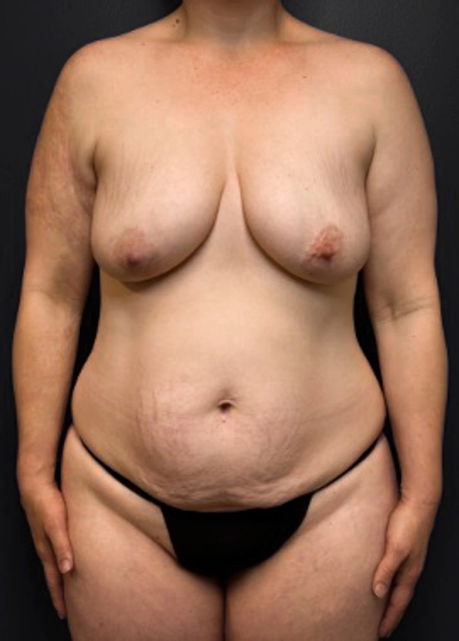 Abdominoplasty-Case--5347 | Before Tummy Tuck 1