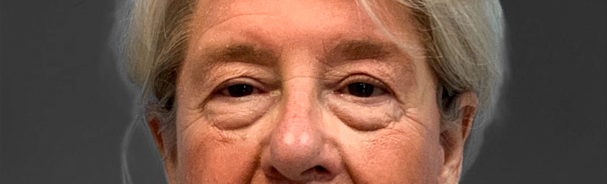 Blepharoplasty-Case--3336 | Before Dr. Arjun Kanuri 1