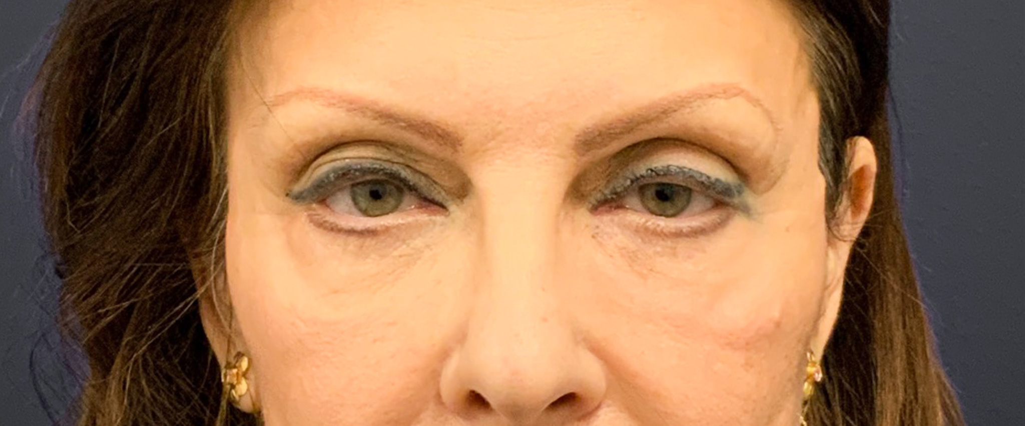 Blepharoplasty-Case--6272 | Before Dr. Arjun Kanuri 1
