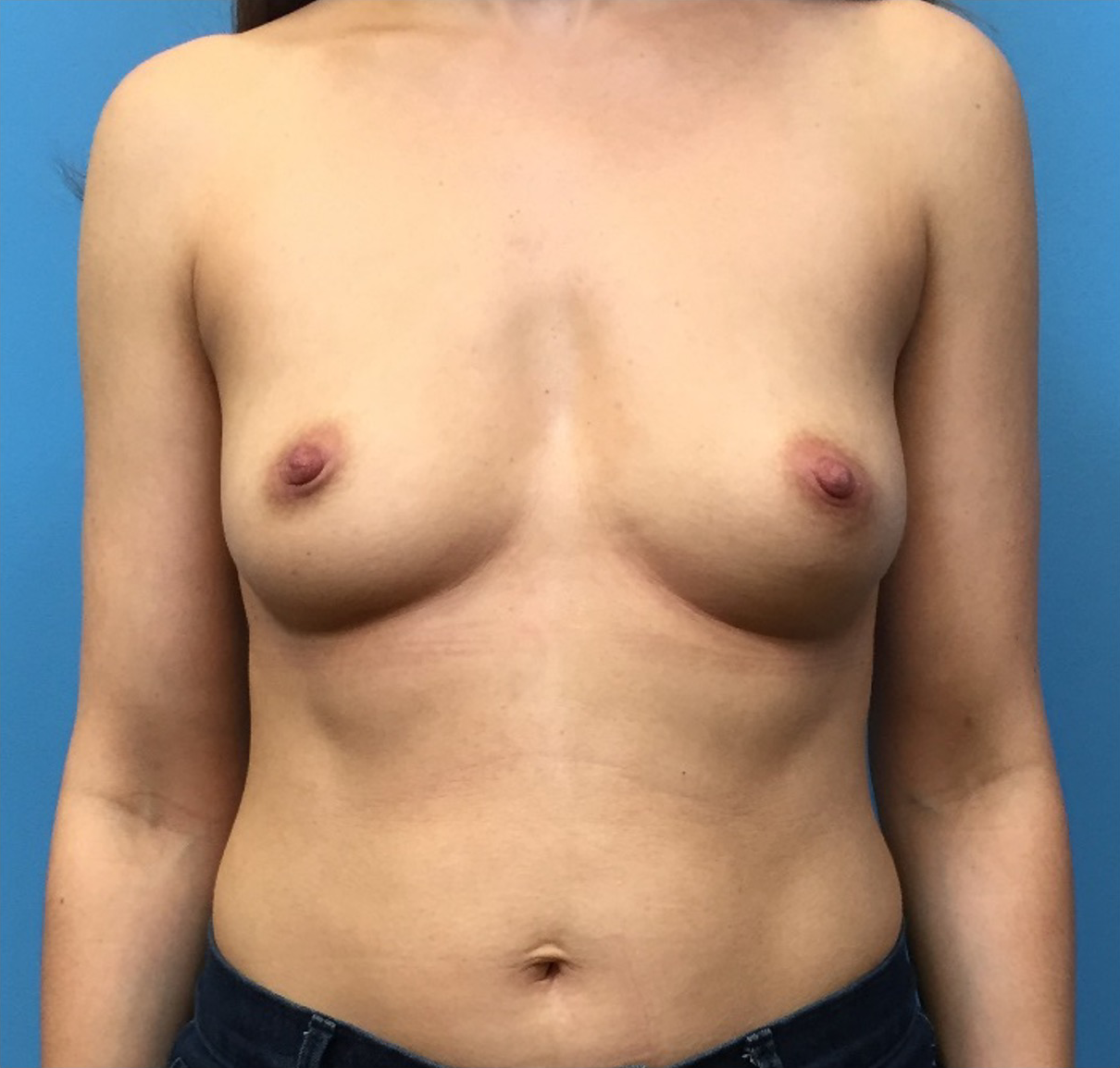 Breast-Augmentation-Case--226 | Before Dr. Samir Rao 1
