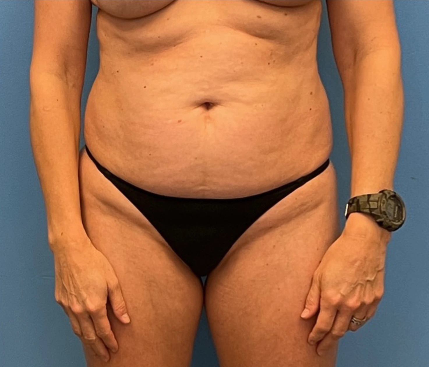 Case--253 | Before Liposuction 1