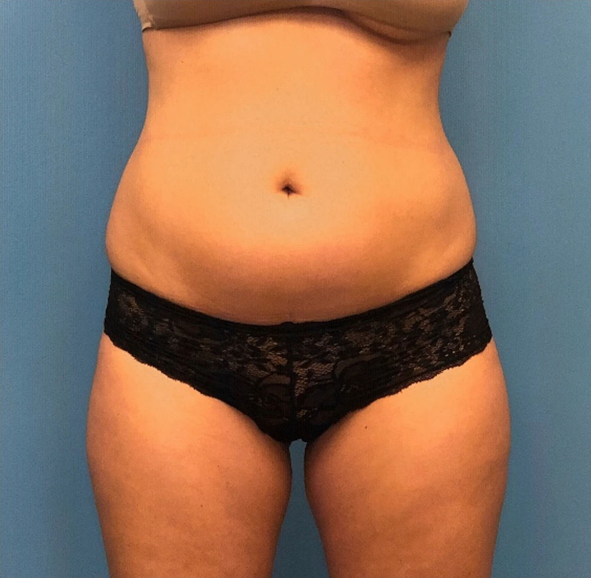 Lipo-360-Case--277 | Before Body 1