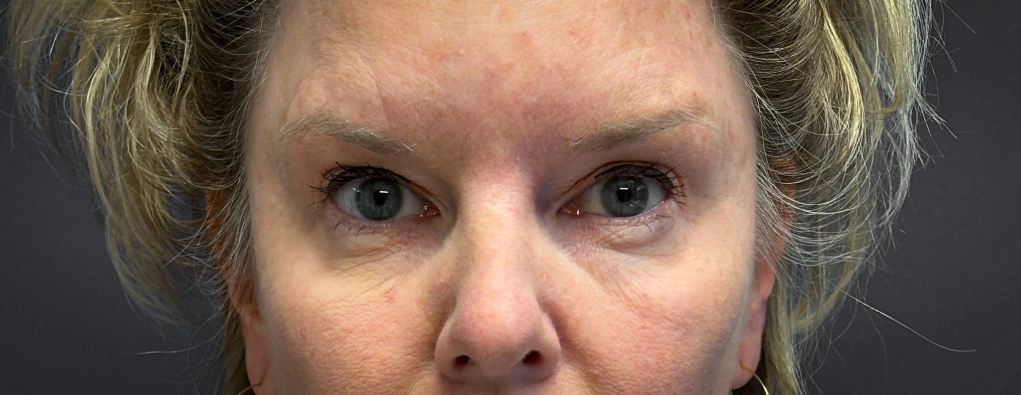 Blepharoplasty-Case--7015 | Before Dr. Arjun Kanuri 1