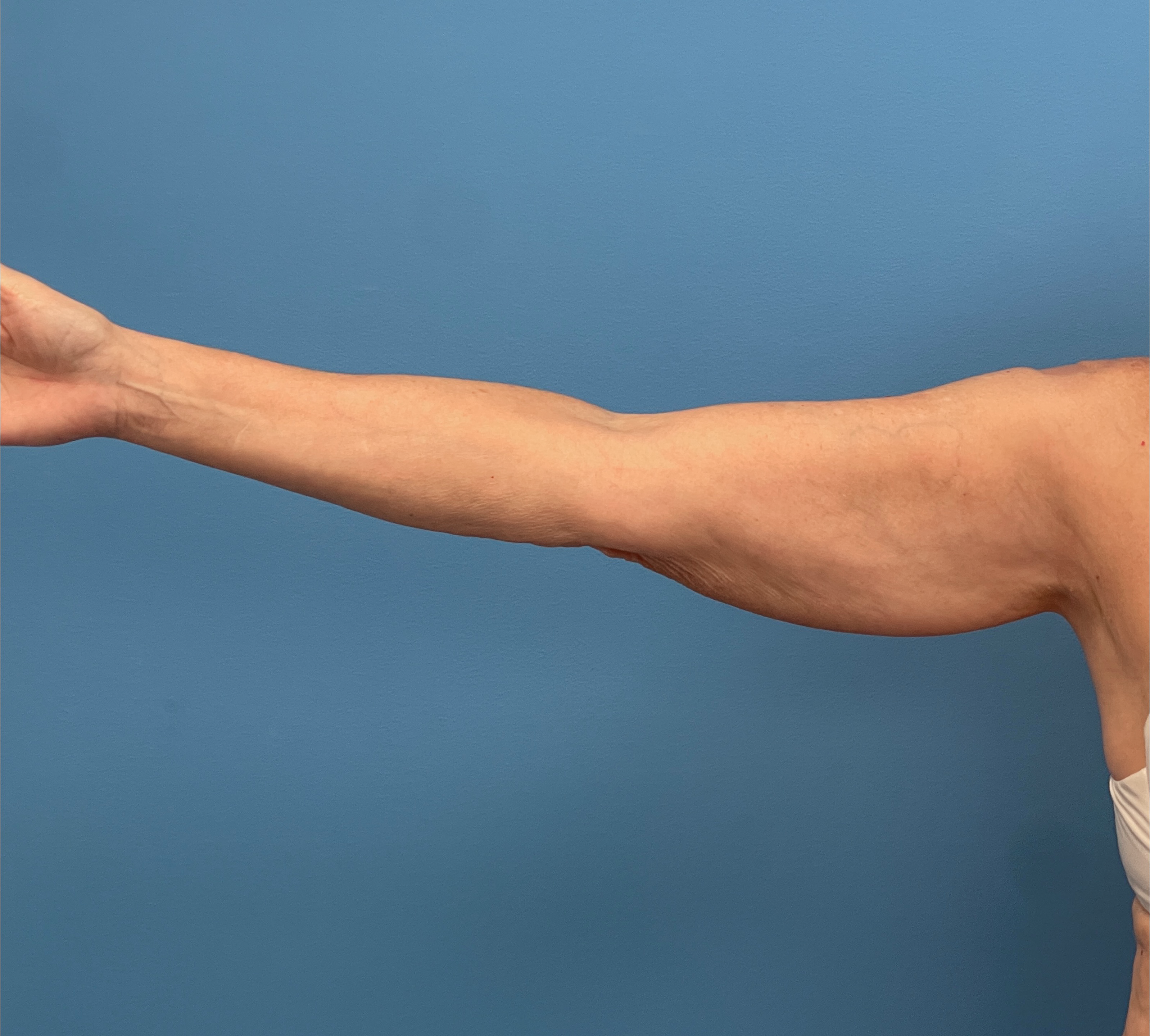 Liposuction-Case--23690-2 | Before Liposuction 2