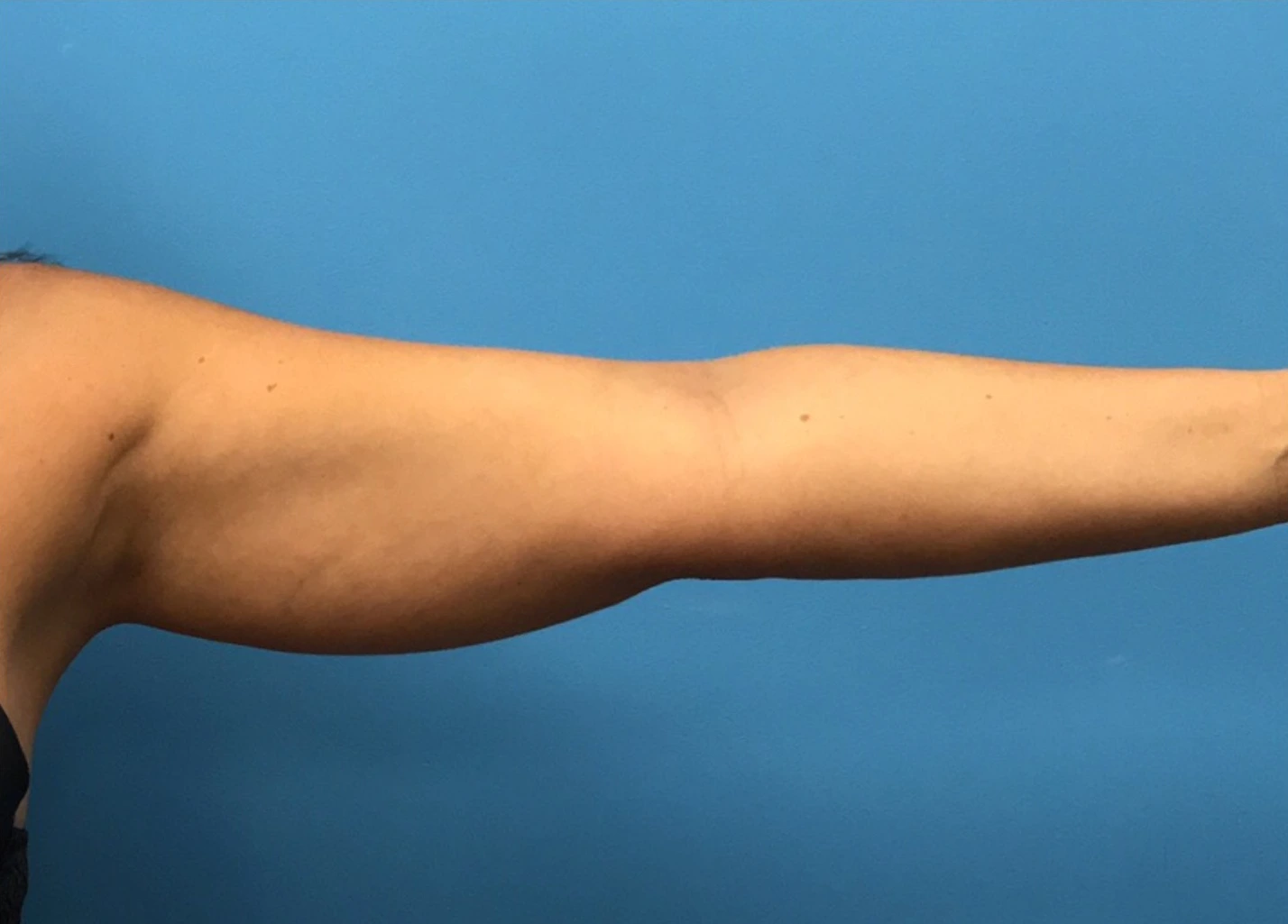 Case--280 | Before Liposuction 4