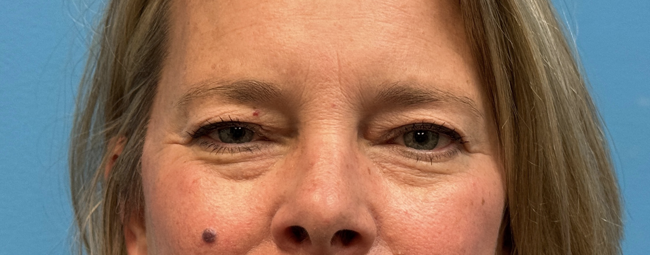 Blepharoplasty-Case--13622 | Before Eyelid Surgery 2