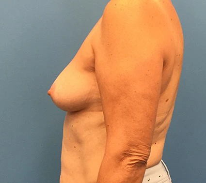 Case--133 | Before Breast Reconstruction 2