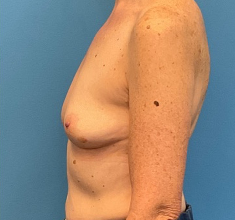 Breast-Augmentation-Case--27374 | Before Breast Augmentation 3