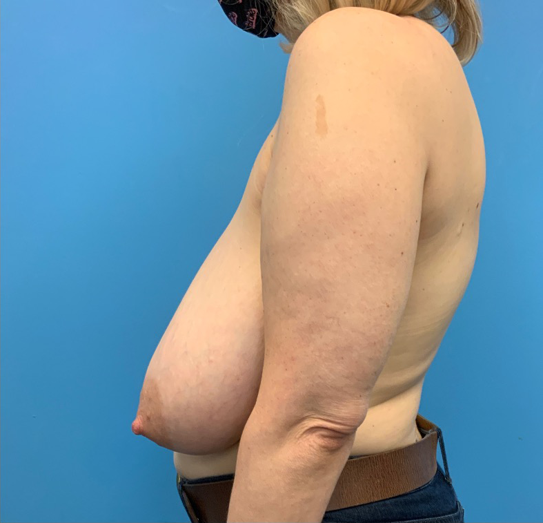 Breast-Reduction-Case--19057 | Before Breast Reduction 5